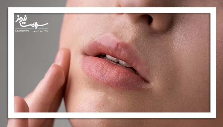 چطور پوسته پوسته شدن اطراف لب را کنترل کنیم؟ چطور پوسته پوسته شدن اطراف لب را کنترل کنیم؟