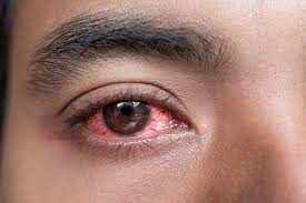 ابتلای هزاران نفر به بیماری قرمزی چشم در تانزانیا
