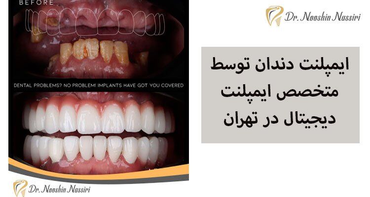 ایمپلنت دندان توسط متخصص ایمپلنت دیجیتال در تهران