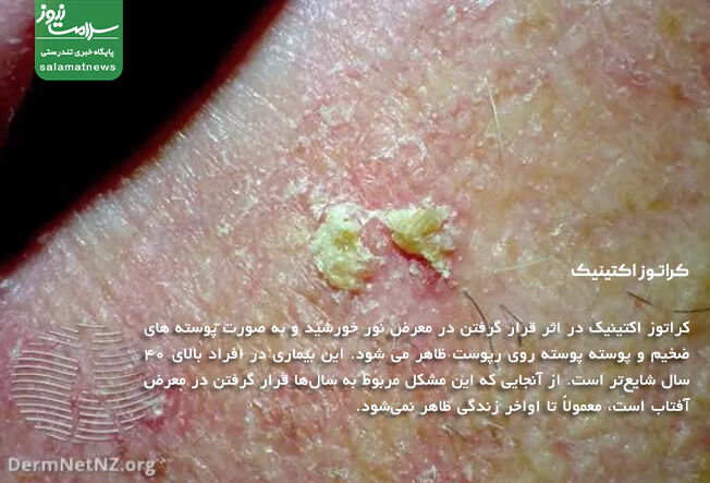 کراتوز اکتینیک