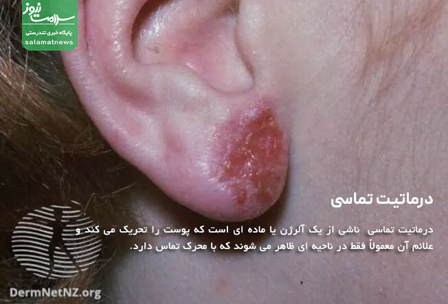 درماتیت تماسی