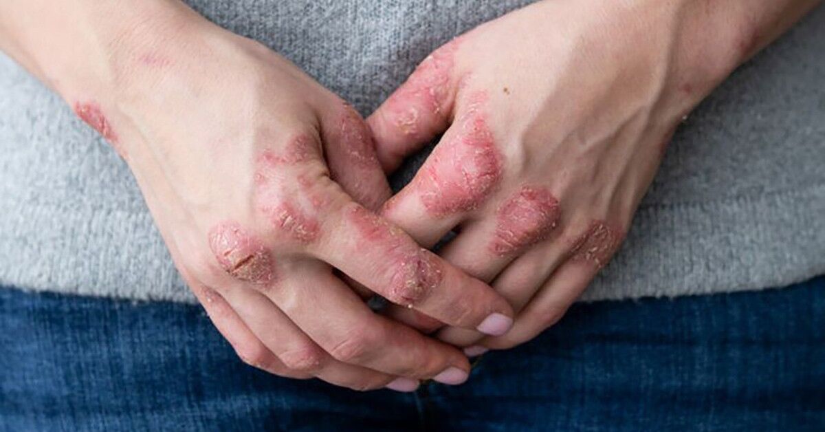 مبتلایان به پسوریازیس شدید در معرض خطر بیشتر بیماری قلبی هستند مبتلایان به پسوریازیس شدید در معرض خطر بیشتر بیماری قلبی هستند