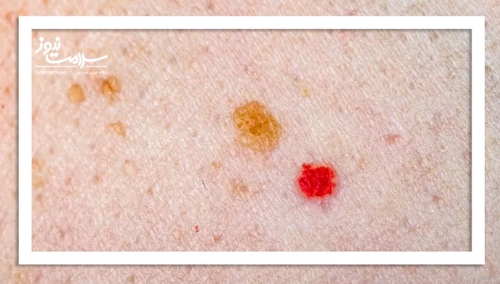 آنژیوم گیلاسی