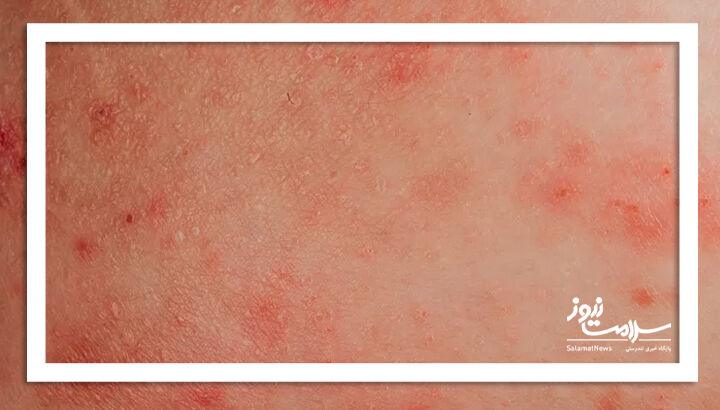 درماتیت تماسی