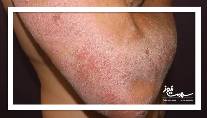 درماتیت آتوپیک (اگزما)
