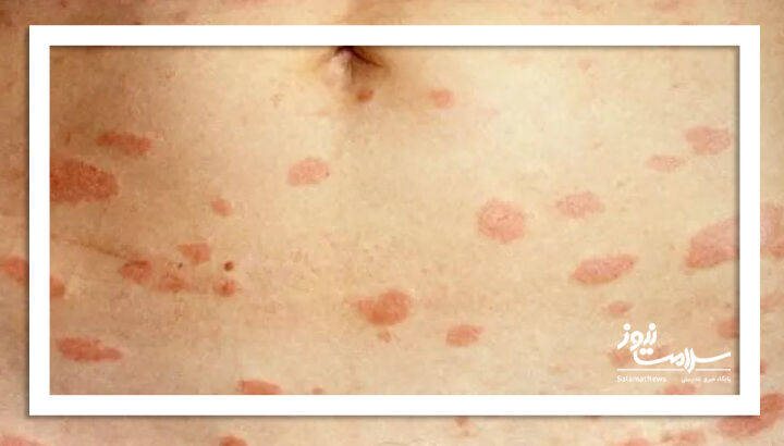 پیتریازیس روزیا