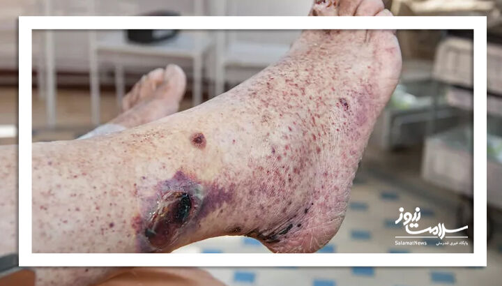 لکه های خونی (پورپورا)