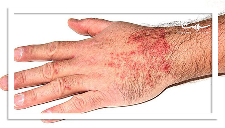 خارش شناگر (درماتیت گردنی)