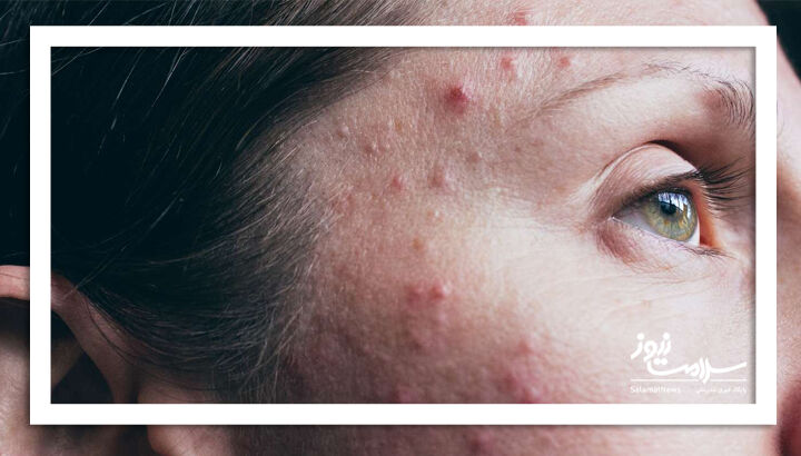 آکنه ولگاریس