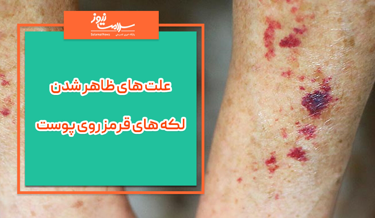 علت های ظاهر شدن لکه های قرمز روی پوست  علت های ظاهر شدن لکه های قرمز روی پوست