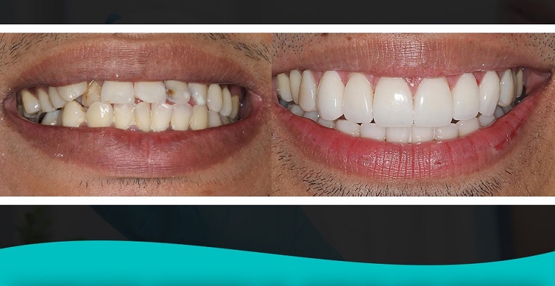 آشنایی با انواع لمینت دندان و علت بالا بودن قیمت