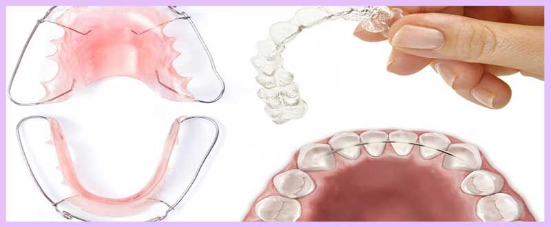 قیمت نگهدارنده های ارتودنسی + مدت زمان استفاده قیمت نگهدارنده های ارتودنسی + مدت زمان استفاده