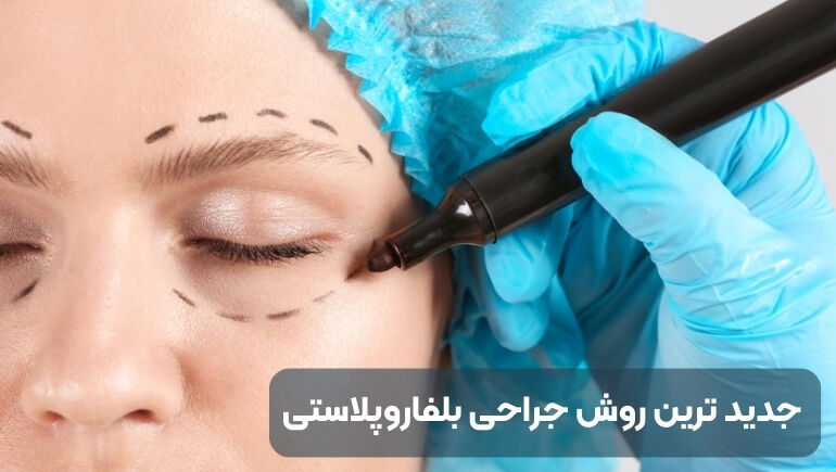 جدید ترین روش جراحی بلفاروپلاستی در کدام کلینیک تهران انجام می شود؟ جدید ترین روش جراحی بلفاروپلاستی در کدام کلینیک تهران انجام می شود؟