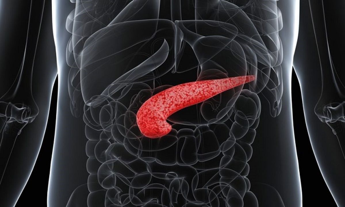 چربی اطراف پانکراس مردان احتمال ابتلا به آلزایمر را افزایش می دهد چربی اطراف پانکراس مردان احتمال ابتلا به آلزایمر را افزایش می دهد