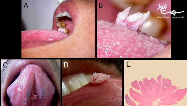 اچ پی وی گل کلمی دهان