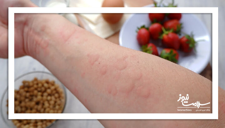 چه غذاهایی در تست آلرژی بررسی می شوند؟