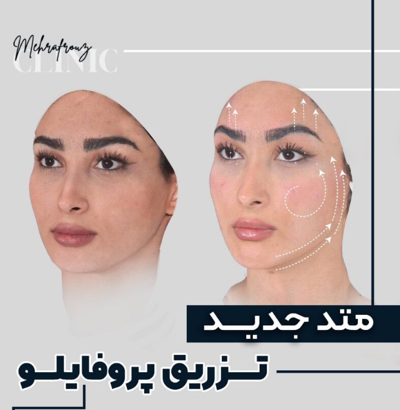 انواع تزریق فیلر به صورت انواع تزریق فیلر به صورت