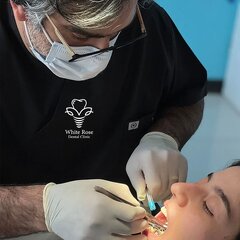 قیمت ایمپلنت دندان در سال جدید + ۵ درصد تخفیف