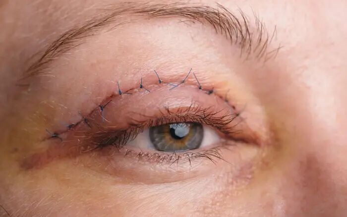 بلفاروپلاستی ، لیفت شقیقه و مزوژل صورت بلفاروپلاستی ، لیفت شقیقه و مزوژل صورت