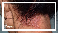 علائم، تشخیص و روش های درمانی اگزمای پوست سر