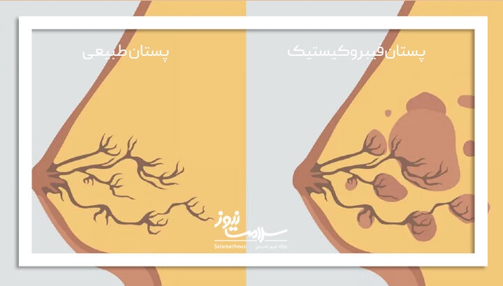 پستان فیبروکیستیک