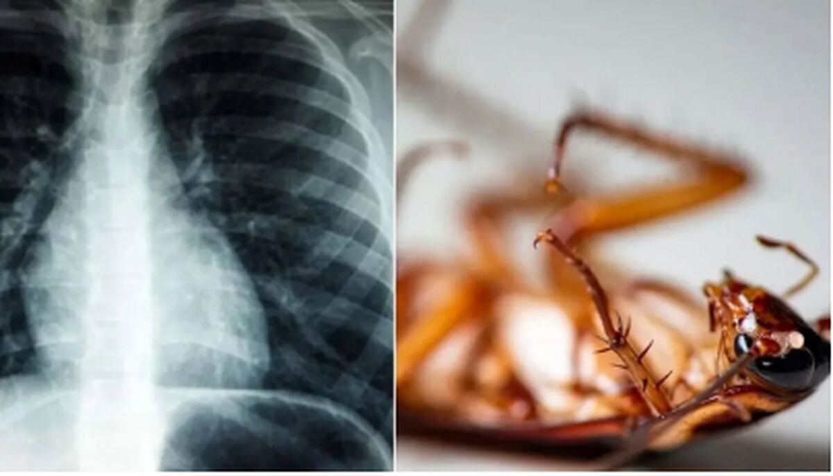 ماجرای خروج یک سوسک از ریه مرد هندی برملا شد ماجرای خروج یک سوسک از ریه مرد هندی برملا شد