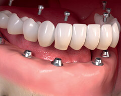 اوردنچر دندان چیست (عکس اوردنچر دندان + هزینه)