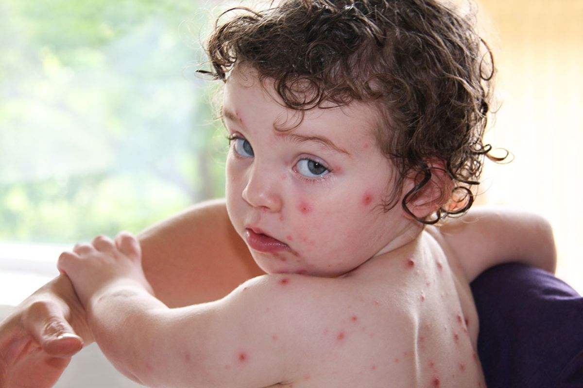 از ابتلای فرزندتان به این بیماری استقبال کنید! از ابتلای فرزندتان به این بیماری استقبال کنید!