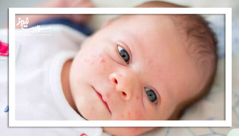 آکنه نوزادی: روش تشخیص و روش های درمانی آن
