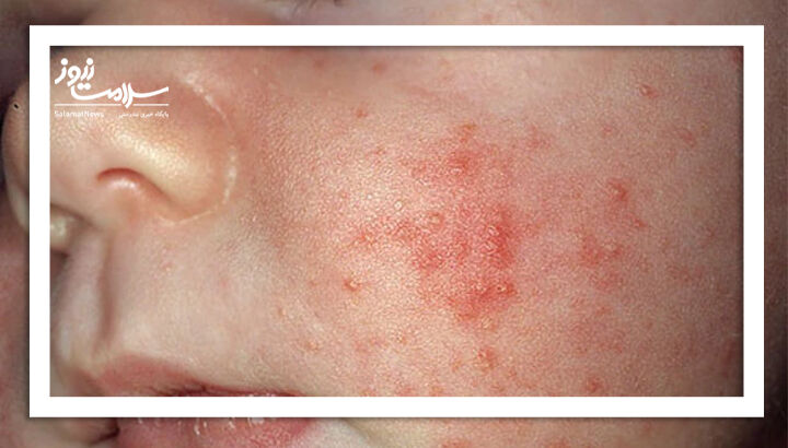 آکنه نوزادی: روش تشخیص و روش های درمانی آن