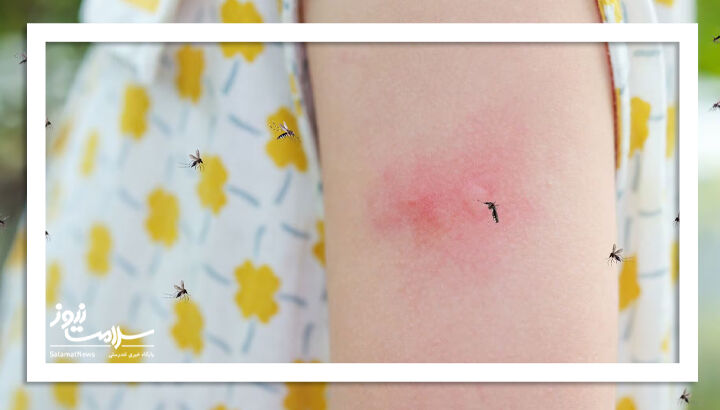 آیا پشه زدگی با خمیر دندان درمان می شود؟ آیا پشه زدگی با خمیر دندان درمان می شود؟