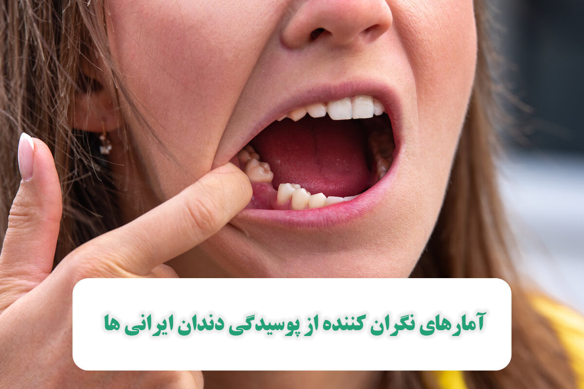 آمارهای نگران کننده از پوسیدگی دندان ایرانی ها