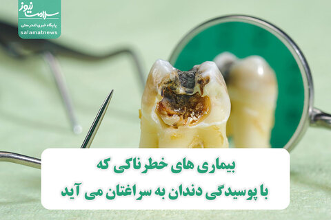 بیماری های خطرناکی که با پوسیدگی دندان به سراغتان می آید