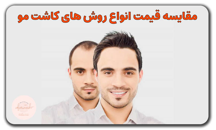 قیمت انواع روش های کاشت مو