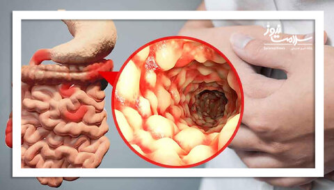 آزمایش خون می تواند بیماری کرون را تشخیص دهد؟