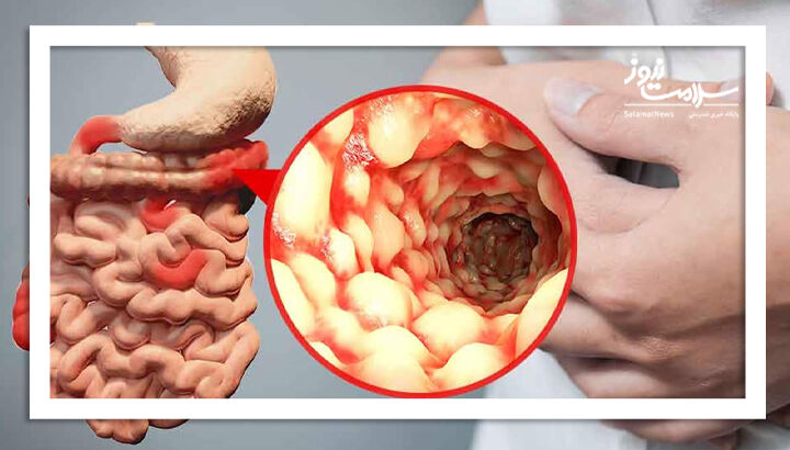 آزمایش خون می تواند بیماری کرون را تشخیص دهد؟ آزمایش خون می تواند بیماری کرون را تشخیص دهد؟