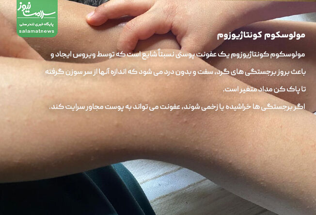 مولوسکوم کونتاژیوزوم