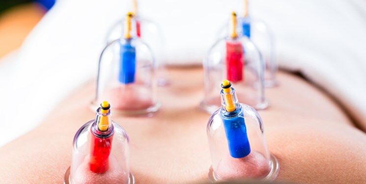 بیمه فصد و حجامت، موافقان و مخالفان چه میگویند بیمه فصد و حجامت، موافقان و مخالفان چه میگویند