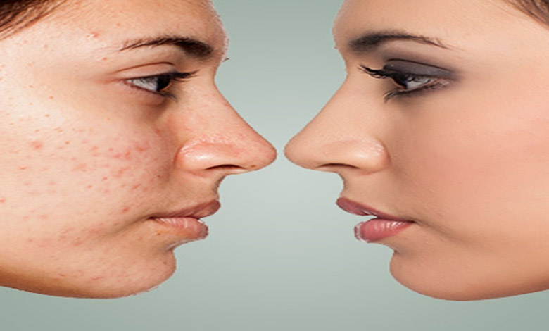 سابسیژن؛ جدیدترین روش جوانسازی و درمان جای جوش