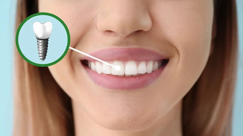 آیا ایمپلنت کره ای خوب است؟ آیا ایمپلنت کره ای خوب است؟