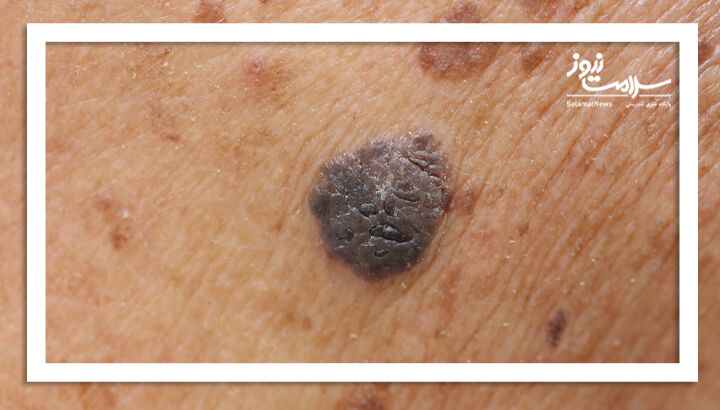 کراتوز سبورئیک