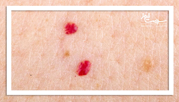 آنژیوم گیلاس