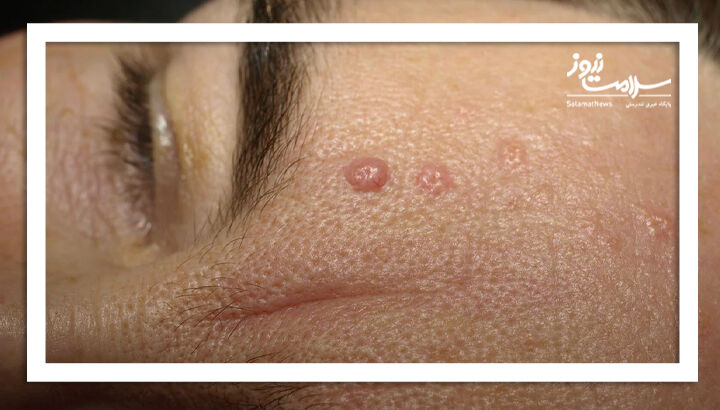 هایپرپلازی سباسه