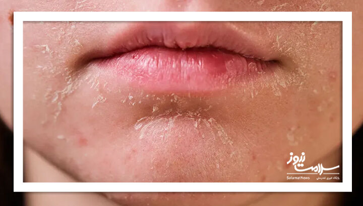 کراتوز اکتینیک