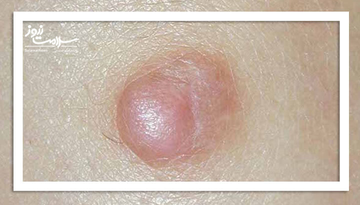 درماتوفیبروم