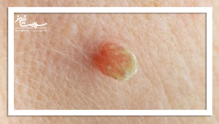 آکروکوردون