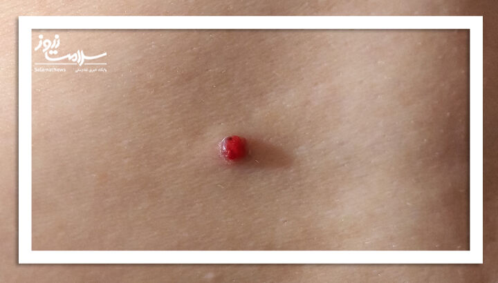 گرانولوم های پیوژنیک