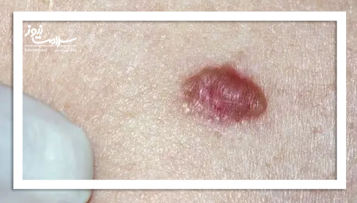 کارسینوم سلول بازال