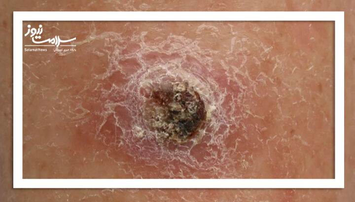 کارسینوم سلول سنگفرشی