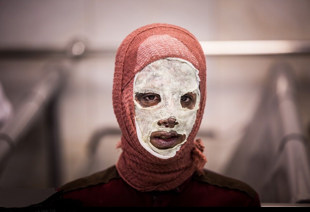 در تامین «لباس»، «پماد» و «پانسمان» سوختگی با مشکل مواجه هستیم در تامین «لباس»، «پماد» و «پانسمان» سوختگی با مشکل مواجه هستیم